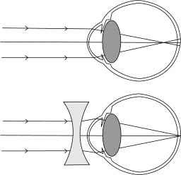 „Myopia-2-3.svg“ von Professor Garantulis, lizenziert unter CC SA 1.0.
https://commons.wikimedia.org/wiki/File:Myopia-2-3.svg
Lizenz: https://creativecommons.org/licenses/sa/1.0/